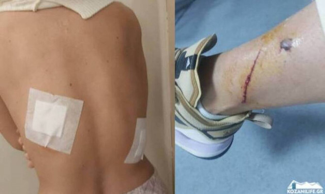 Στιγμές τρόμου για γυναίκα στην Κοζάνη: Της επιτέθηκε σκύλος - «Γλίτωσα από θαύμα» (pics)