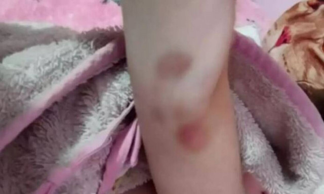 Θάνατος παιδιών στην Πάτρα: Φωτογραφία - ντοκουμέντο με μελανιές στο χέρι της Τζωρτζίνας