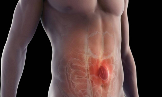 Βουβωνοκήλη: Απαλλαγείτε άμεσα και οριστικά