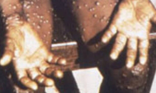 Συναγερμός στη Βρετανία: Φόβοι για εξάπλωση θανατηφόρος παραλλαγής ιλαράς