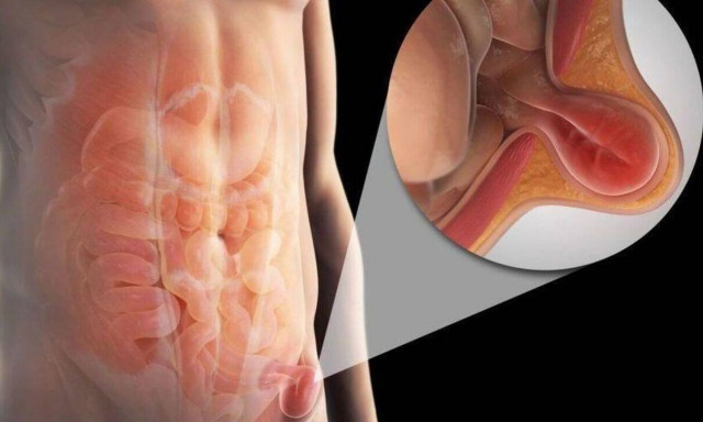 Κοιλιοκήλη και Μετεγχειρητική κήλη: Τα οφέλη της ελάχιστα επεμβατικής χειρουργικής