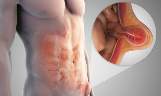 Κήλη: Άμεση και σύγχρονη αντιμετώπιση