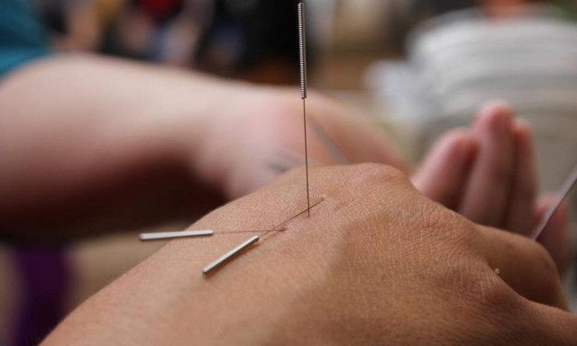 Έρευνα: Ο βελονισμός μπορεί να μειώσει τους χρόνιους πονοκεφάλους
