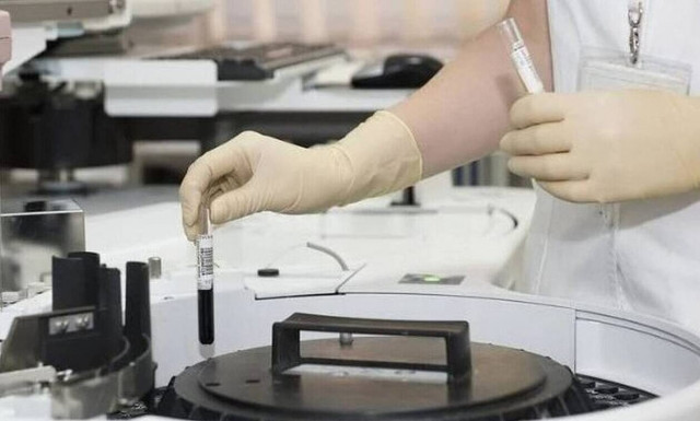 Ευλογιά των πιθήκων: 54 κρούσματα σε όλη την Ελλάδα