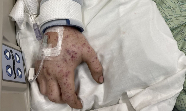 ΗΠΑ: Σε κώμα 20χρονος στο Σινσινάτι - Τσιμπήθηκε 20.000 φορές από μέλισσες-δολοφόνους