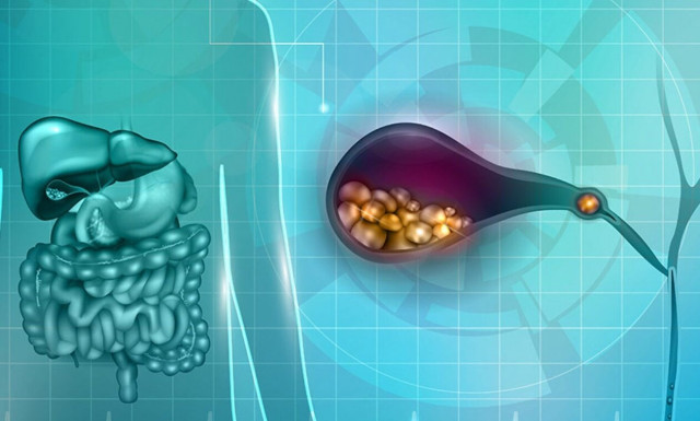 Πέτρες στη χολή; Αντιμετώπιση με λαπαροσκοπική χολοκυστεκτομή