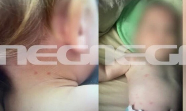 Έγκλημα στην Καβάλα - Σοκαριστικές εικόνες: Σημαδεμένο το κορμάκι του μωρού από τα τσιμπήματα ψύλλων