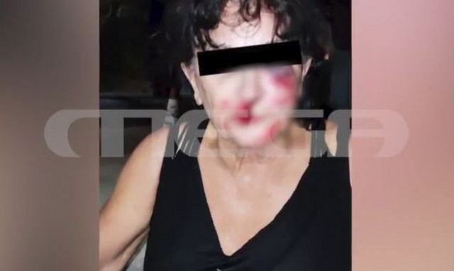 Αίγινα: Φωτογραφίες-ντοκουμέντο από την άγρια επίθεση – Συγκλονίζει η μαρτυρία της 67χρονης