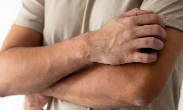 Μπιμεκιζουμάμπη, νέα θεραπευτική επιλογή στην Ψωρίαση κατά πλάκας