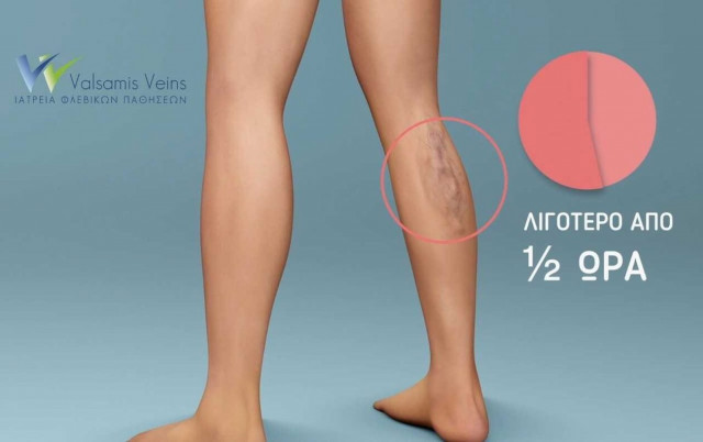 Κιρσοί και ευρυαγγείες: Πώς θεραπεύονται