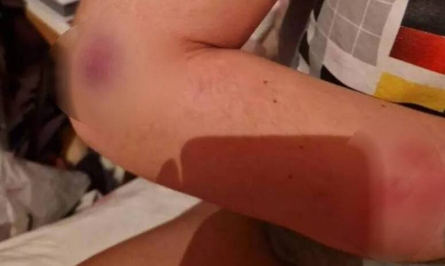 Πάτρα: Ξυλοδαρμό από το σύντροφό της κατήγγειλε 31χρονη – «Θα με σκοτώσει» (ΣΚΛΗΡΕΣ ΕΙΚΟΝΕΣ)