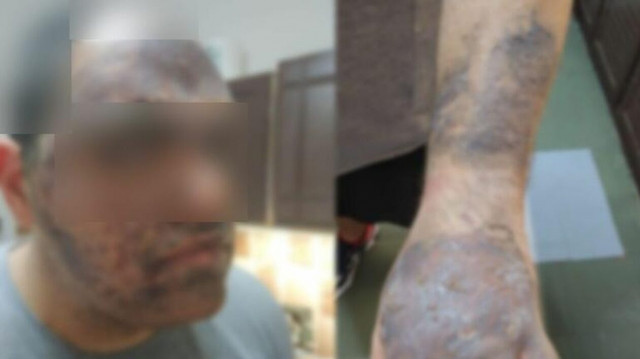 Ηράκλειο: Φρίκη για 22χρονο εργαζόμενο -  Κάηκε με καυτό λάδι σε ξενοδοχείο