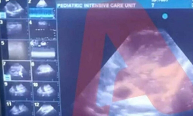 Δίκη Πισπιρίγκου: Βίντεο ντοκουμέντο - Το υπερηχογράφημα της καρδιάς της Τζωρτζίνας μετά την ανακοπή