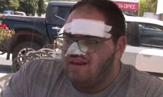 Κρήτη: Στην επιθεώρηση εργασίας ο ανασφάλιστος μάγειρας που υπέστη εγκαύματα από καυτό λάδι