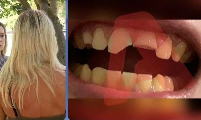 Πάτρα: Ξεσπά η μητέρα του 12χρονου που τον χτύπησε συμμαθητής του και του έσπασε τα δόντια