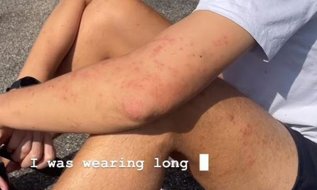 Γερμανία: Εφιάλτης για ζευγάρι τουριστών από την Αυστραλία - Τους δάγκωσαν κοριοί μέσα σε τρένο