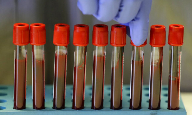 Αμυλοείδωση: H ύπουλη νόσος με τα πολλά πρόσωπα