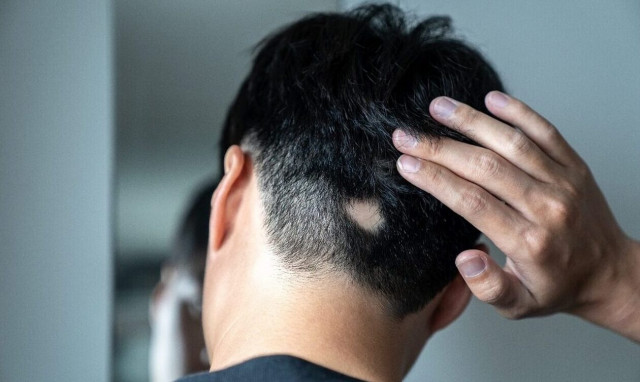 Γυροειδής Αλωπεκία: Το μεγάλο ψυχολογικό φορτίο για τους πάσχοντες