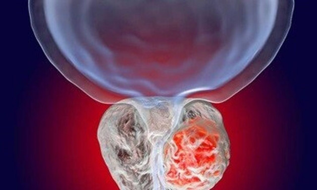 Καρκίνος Προστάτη: Κάναμε βήματα παραπέρα στην αντιμετώπιση του;