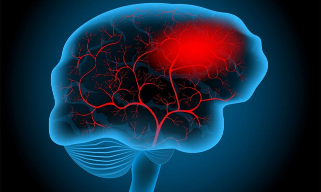 Εγκεφαλικό: Οι παράγοντες κινδύνου και ο ρόλος της ηλικίας