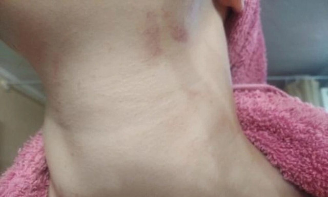 Εφιάλτης για 28χρονη: Πήδηξε από δεύτερο όροφο για να γλιτώσει από τον ξυλοδαρμό του συντρόφου της