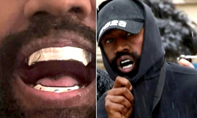 Κάνιε Γουέστ: Αφαίρεσε τα δόντια του και έβαλε μασέλα από τιτάνιο αξίας 850.000 δολαρίων
