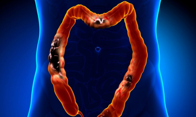 Καρκίνος παχέος εντέρου: Το πρώτο εμβόλιο είναι γεγονός