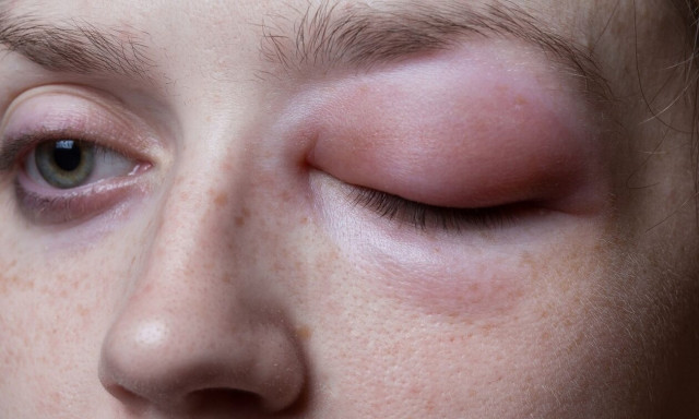 Κληρονομικό αγγειοοίδημα: Τι είναι; Μπορεί να θεραπευτεί;