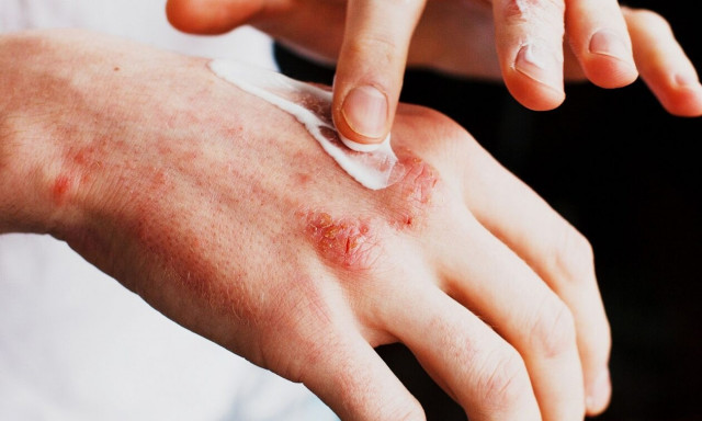 Έκζεμα: Πώς επηρεάζεται από την κλιματική αλλαγή