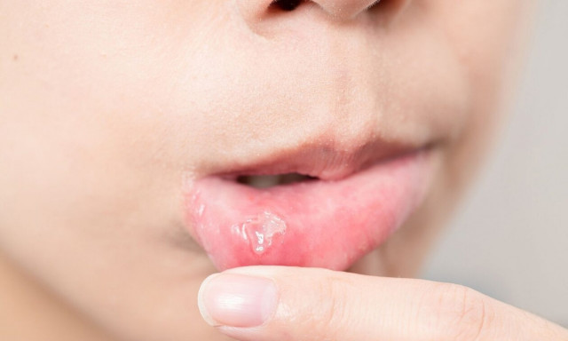 Στοματίτιδα – Τι πρέπει να ξέρουν οι γονείς με απλά λόγια