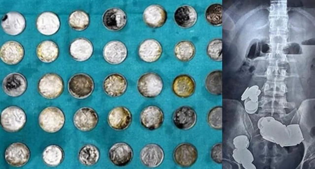 Κατάπιε  39 κέρματα και 37 μαγνήτες για να «χτίσει» σώμα - Δείτε τι έπαθε