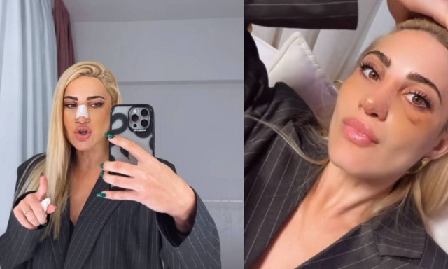 Ιωάννα Τούνη: Έβγαλε τον γύψο και αποκάλυψε πόσο κόστισε η πλαστική στη μύτη