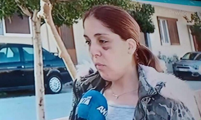 Άργος-Πρώτη φορά η 32χρονη με μώλωπες στο πρόσωπο: «Με χτυπούσε από όταν πέθανε η μάνα του»
