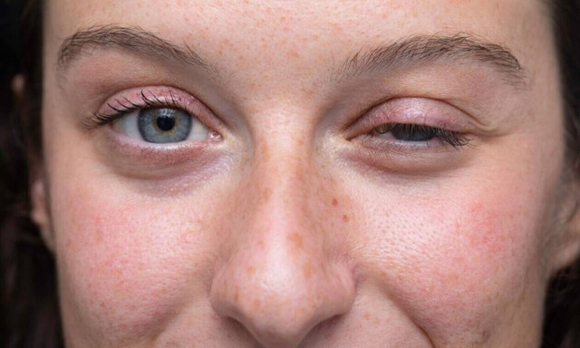 Πανευρωπαϊκή διαμαρτυρία για την υποστήριξη της αλλαγής στη Μυασθένεια Gravis