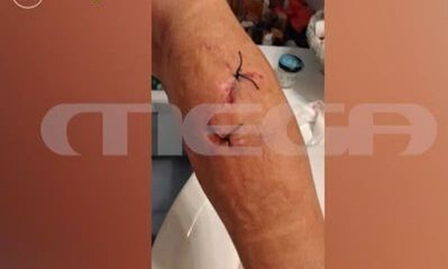 Ραφήνα: «Με έριξαν κάτω και άρχισαν να με δαγκώνουν», λέει η γυναίκα που δέχθηκε επίθεση από σκυλιά