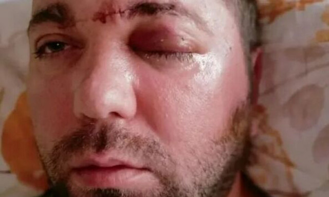 Σοκαριστικές εικόνες: Εμφύτευμα δοντιού του έφτασε στον... εγκέφαλο!