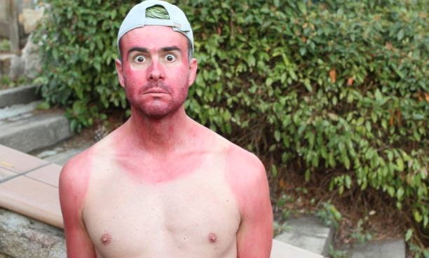 Πώς να αντιμετωπίσετε το ηλιακό έγκαυμα - Τι να αποφεύγετε