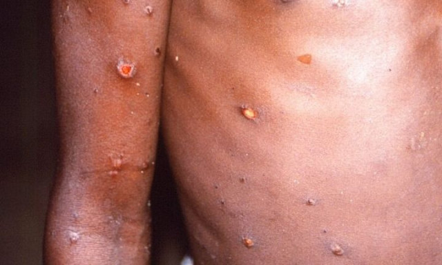 Σε κατάσταση έκτακτης υγειονομικής ανάγκης όλη η Αφρική λόγω της ευλογιάς των πιθήκων