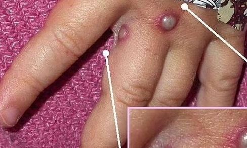 Ευλογιά των πιθήκων: Ο ΠΟΥ κήρυξε παγκόσμια κατάσταση έκτακτης ανάγκης