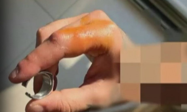 Χαλκιδική: Φώναξαν ηλεκτρολόγο για να αφαιρέσει δαχτυλίδι από χέρι ασθενούς