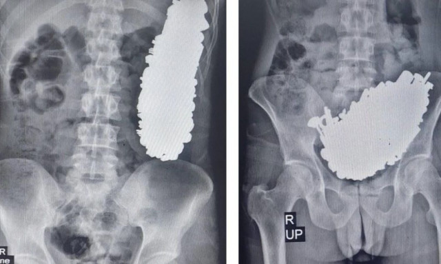 Απίστευτο: Άνδρας είχε καταπιεί 450 μεταλλικά αντικείμενα - Τι αναφέρουν οι... χειρουργοί