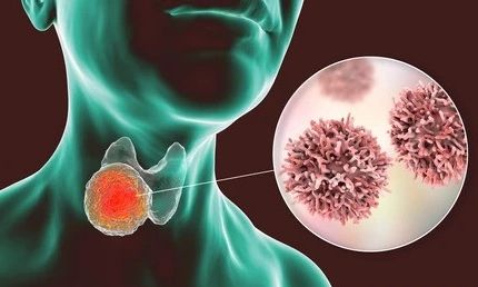 Καρκίνος θυρεοειδούς – ποια είναι τα βήματα για τη σωστή αντιμετώπισή του