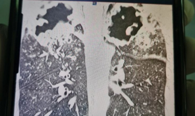 Το μοιραίο λάθος ενός 33χρονου που του κατέστρεψε τους πνεύμονες