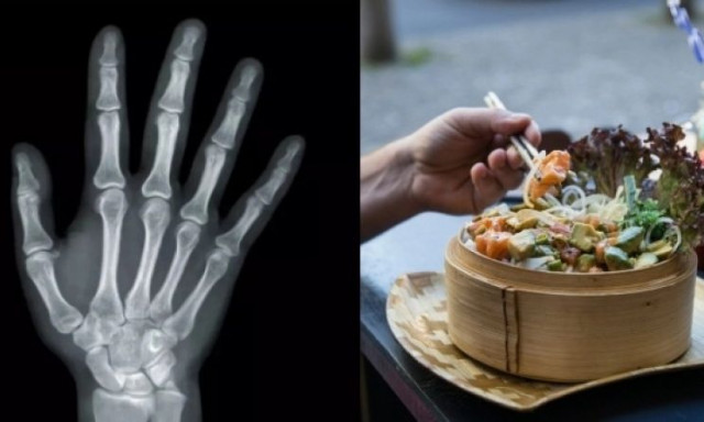 Φοιτητής έχασε όλα του τα άκρα όταν έφαγε το φαγητό που είχε περισσέψει από τον συγκάτοικό του