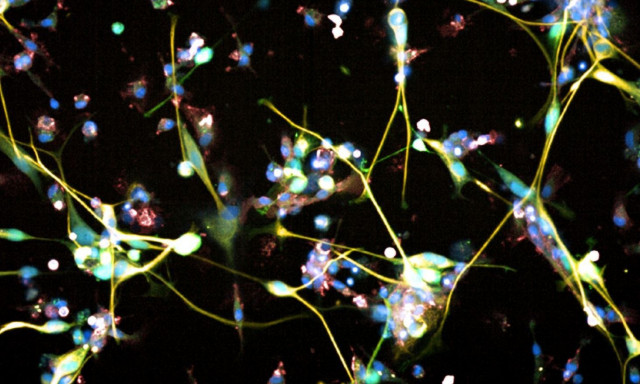 Γλοιοβλάστωμα: Ελπίδες για τη θεραπεία του θανατηφόρου τύπου καρκίνου του εγκεφάλου