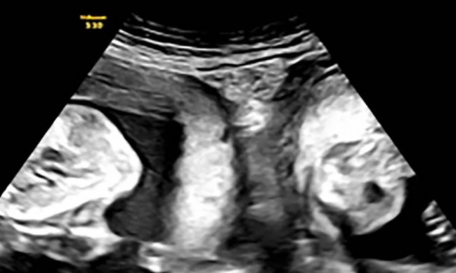 Κίνα: Γυναίκα με δύο μήτρες γέννησε δίδυμα - Ένα από κάθε μια