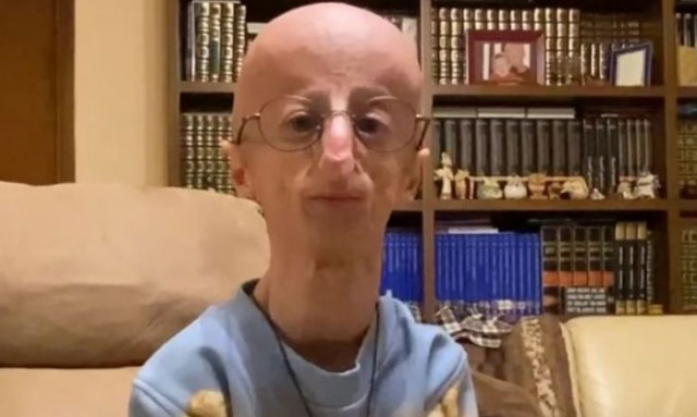 Πέθανε στα 28 του ο Σάμι Μπάσο - Η προγηρία και η προειδοποίηση των γιατρών στους γονείς του