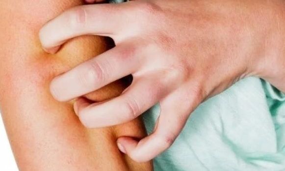 Χανιά: «Νορβηγική ψώρα» - Μέτρα για μαθητές και δασκάλους