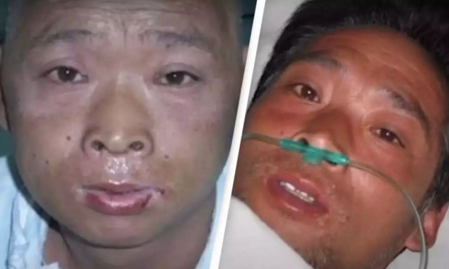 Ο άνθρωπος υπέστη τον πιο οδυνηρό θάνατο που έχει καταγραφεί - Έκλαιγε αίμα και έλιωνε το δέρμα του