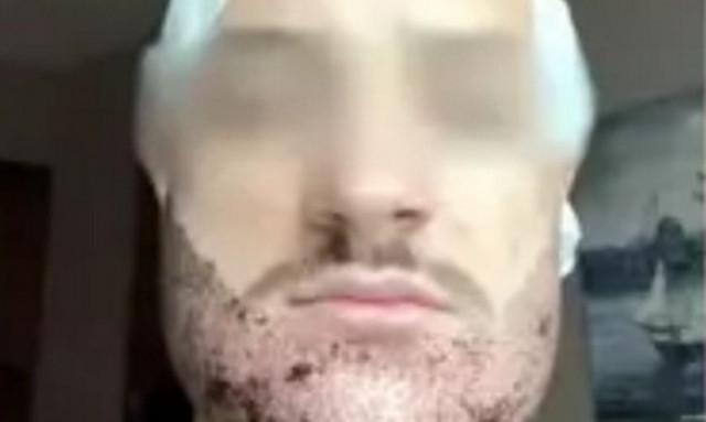 Ανείπωτη τραγωδία: Φοιτητής αυτοκτόνησε μετά από ανεπιτυχή μεταμόσχευση γενειάδας